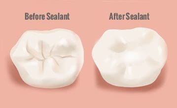 Dental Sealant Program Canceled for 2021